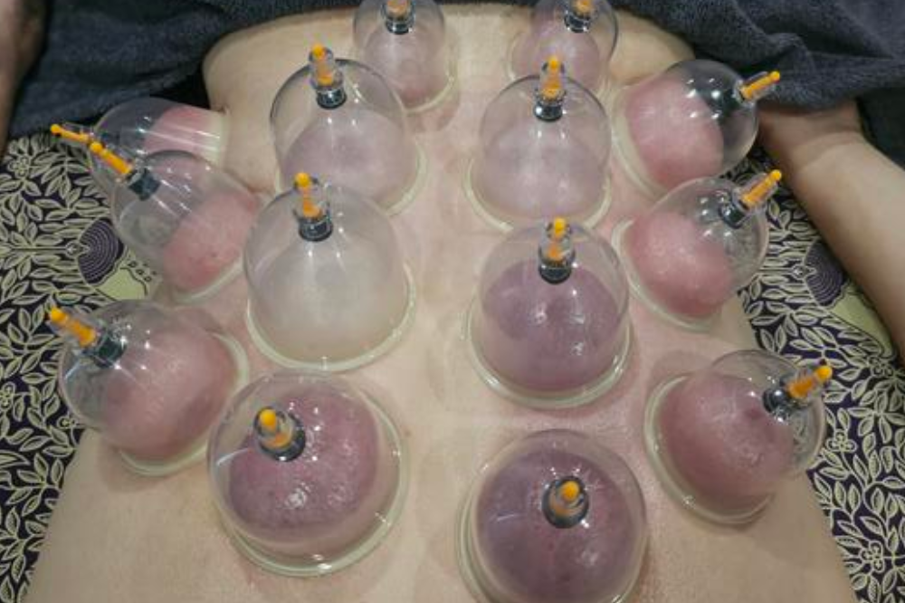 Dry Cupping Therapy